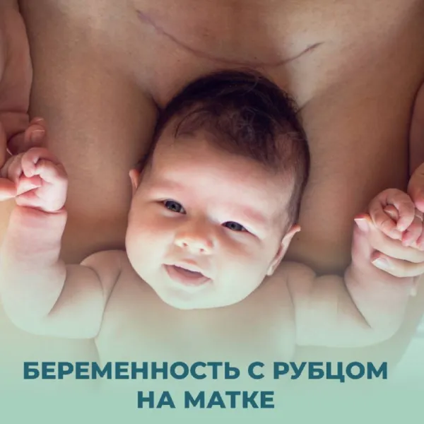 Беременность с рубцом на матке: особенности и риски